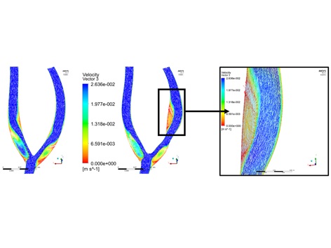 Velocity vectors in a carotid artery in healthy and pathological cases